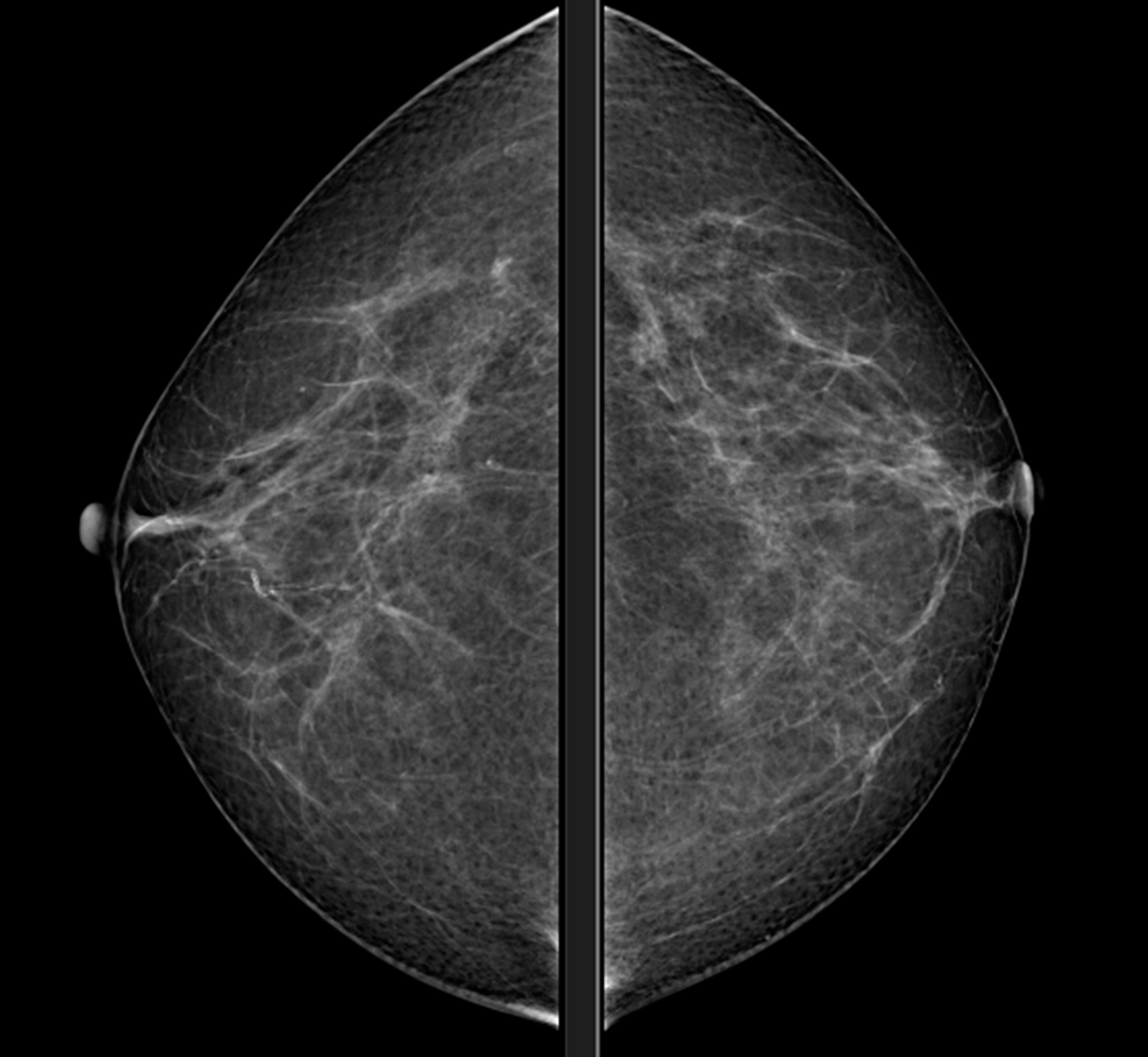 Mammography